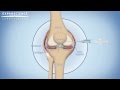Viscosupplementation Knee Injections
