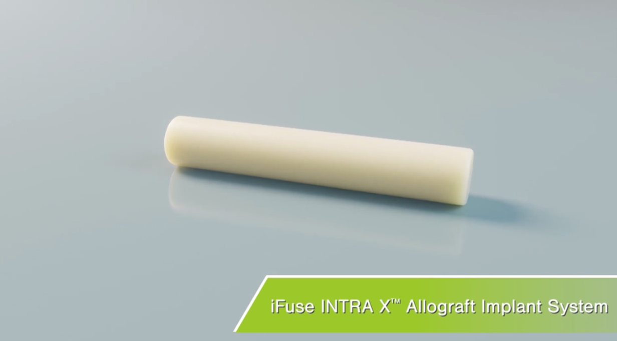 iFuse INTRA X Allograft Implant System